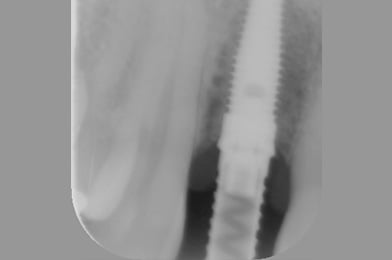 3. X Ray Of Implant Placed