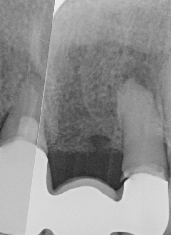 Implant Case 3 2 Before