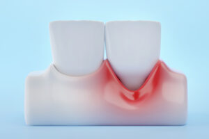 , Addressing your periodontal concerns