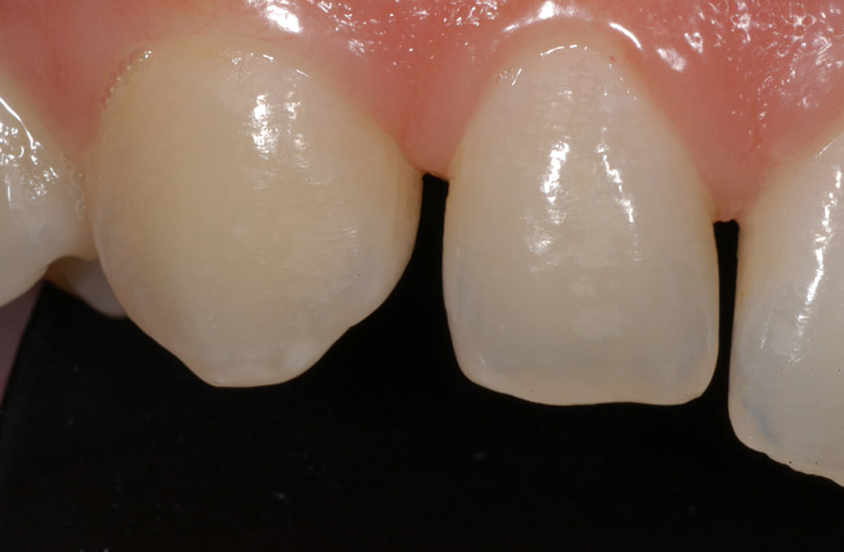 2. Gaps Right Side 1