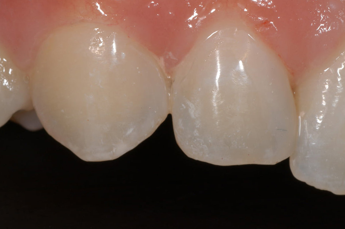4. Gaps Closed With Composite Right Side 1