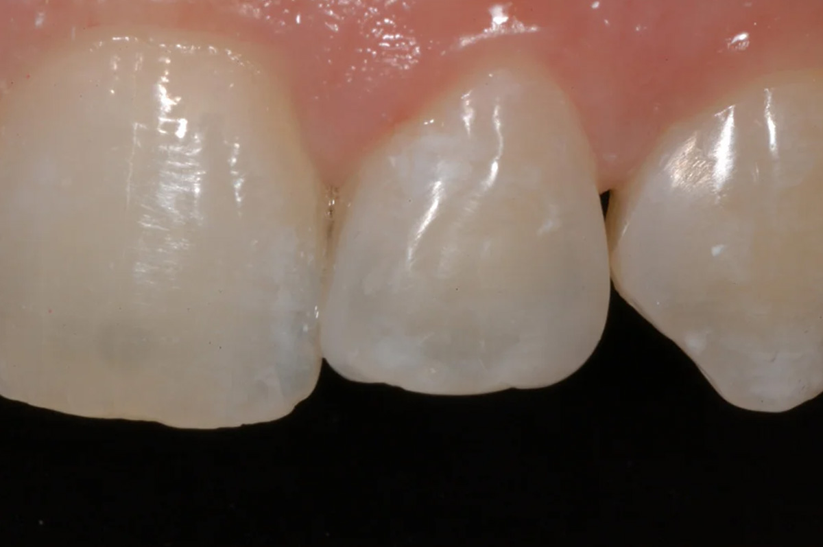 5. Gaps Closed With Composite Left Side