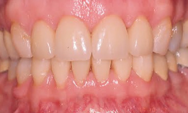 Veneers2 After1