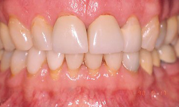 Veneers2 Before1