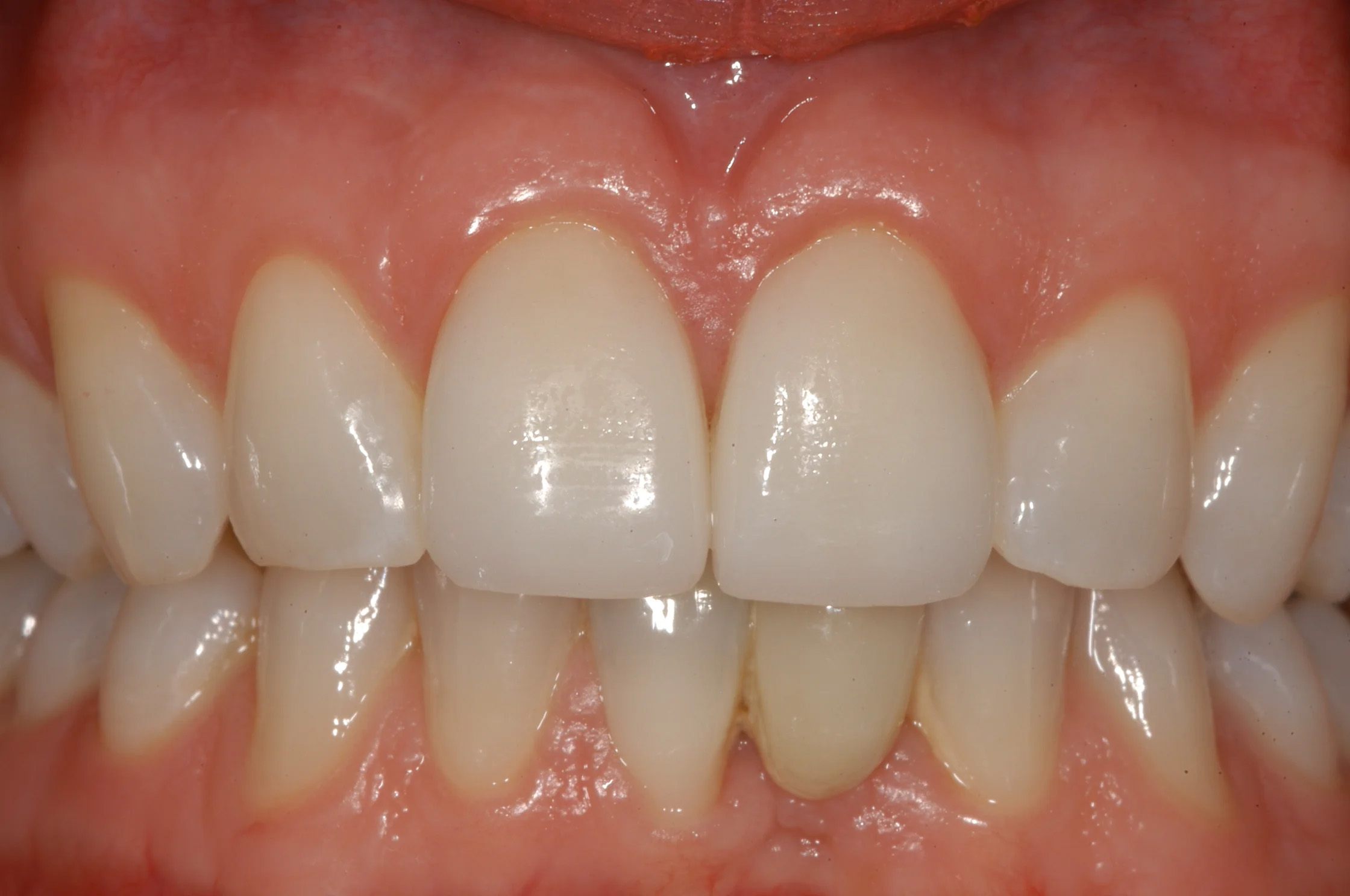 Veneers3 After