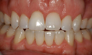 Whitening2 After
