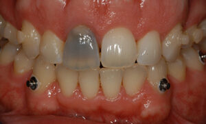 Whitening2 Before
