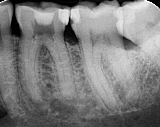 RCT Case 2 Before