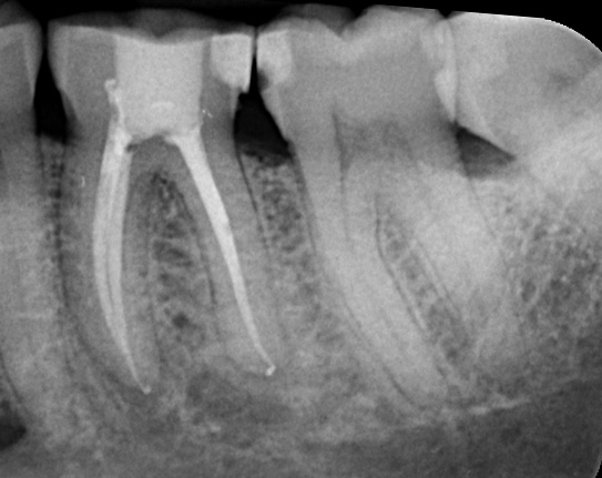 RCT Case 2 After
