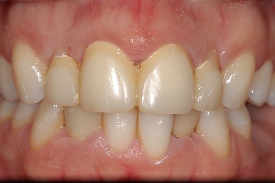 Excess Gum Removal Essex Specialist Periodontist Upminster